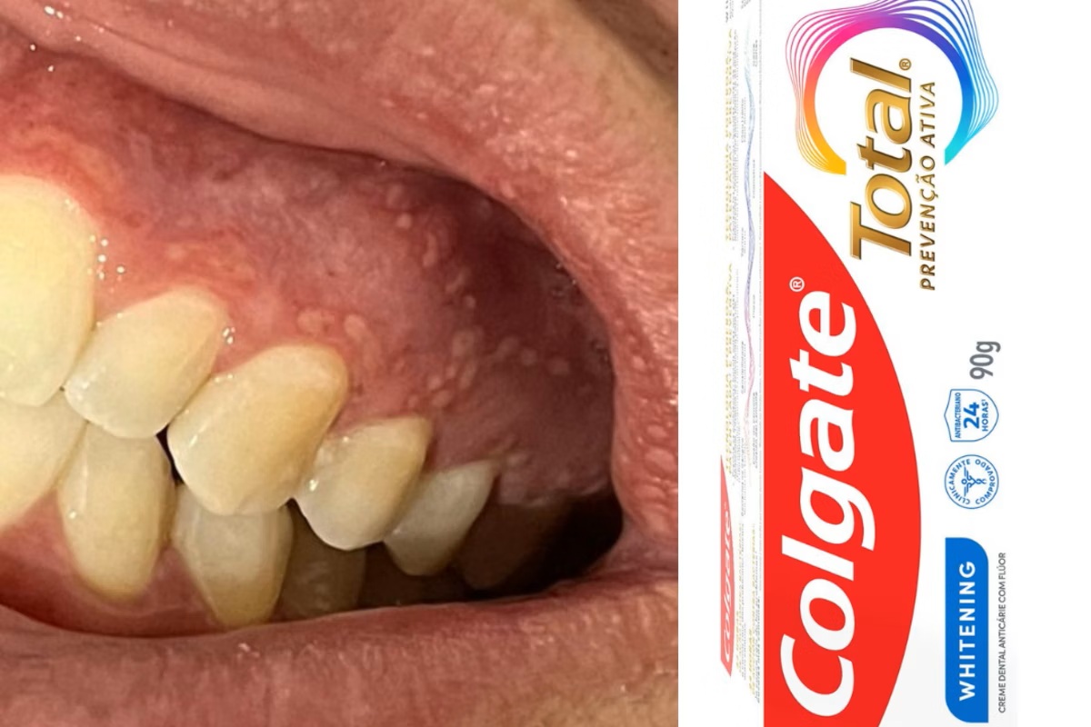 Nova proibição: Anvisa volta a interditar pasta de dente da Colgate